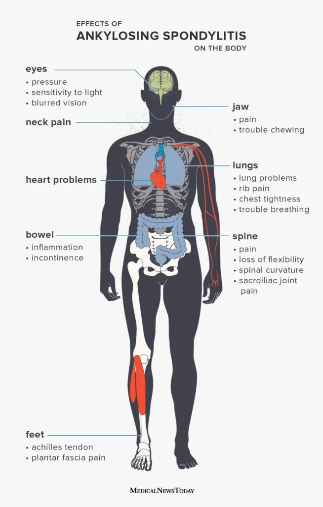 295508 Effects Of Ankylosing Spondylitis 1296x1160 Desktop 654x1024 1